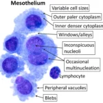 Mesothelium Cancer treatment