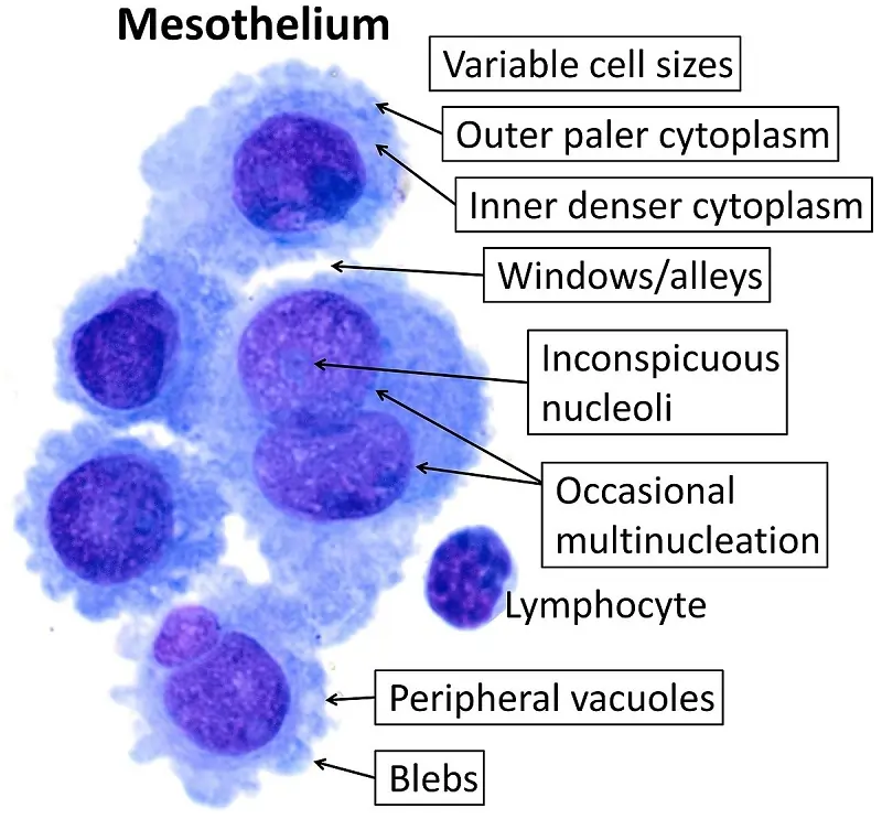 Mesothelium Cancer treatment