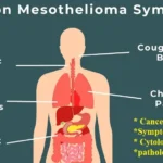 mesothelioma Treatment - Cancer Treatment