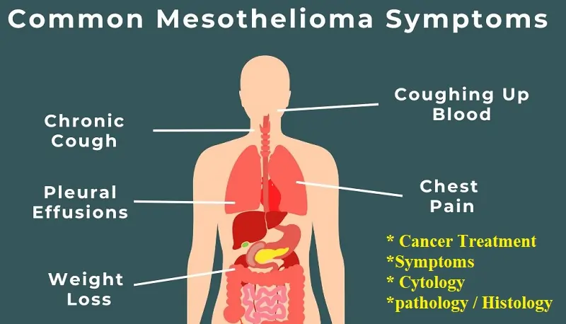 mesothelioma Treatment - Cancer Treatment